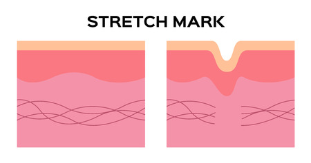 stretch mark and collagen vectorのイラスト素材
