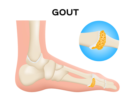 gout in human foot vector / human, anatomy