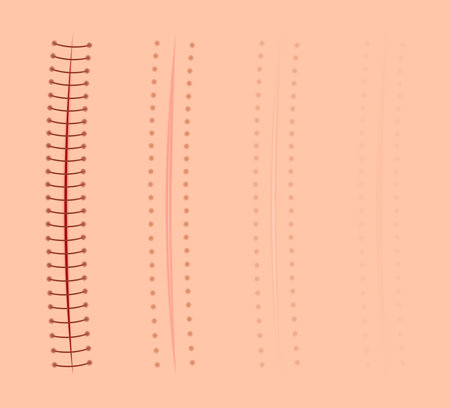 healing of surgical stitches on the skin / Sutures / scarのイラスト素材