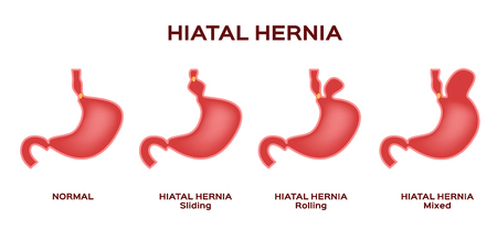 Hiatal hernia / stomach vectorのイラスト素材