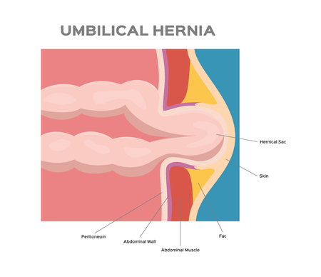umbilical hernia / intestine / human anatomy / belly vectorのイラスト素材