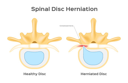 Spinal disc herniation / human back infographic vectorのイラスト素材