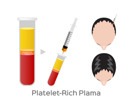 Platelet-Rich plasma procedure stages / prp / Centrifuge vector / cure Baldness / hair conceptのイラスト素材