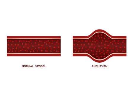 aneurysm blood vessel / anatomy vectorのイラスト素材