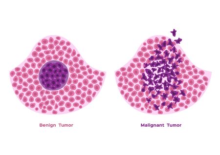 cancer and tumor cell stage and development vector malignant and benign typeのイラスト素材