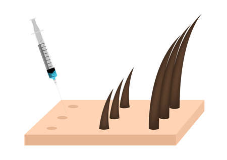 Platelet-Rich plasma . prp . hair growth vector on white backgroundのイラスト素材