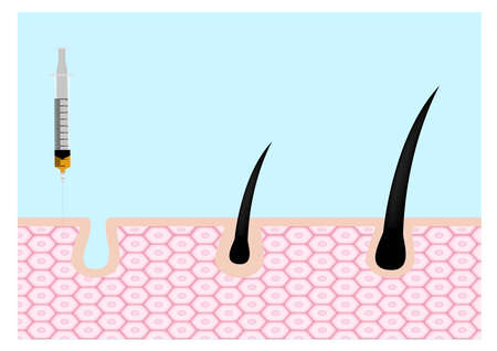 Platelet-Rich plasma . prp . hair growth vector on white backgroundのイラスト素材