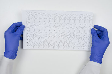 A doctor in blue gloves holds in his hands an ECG with rhythm disturbance - atrial flutter. high quality photoの写真素材