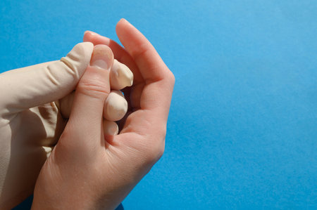 The doctor examines the affected nails-onycholysis, close-up on a blue background.Separation of the nail plate from the nail bed after manicure. The concept of healthy lifestyle, podology. copyspace.の写真素材