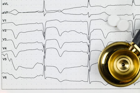 ECG. Myocardial infarction on ECG, stethoscope and pills for treatment. Angina. Chest pain. Close-up.の写真素材