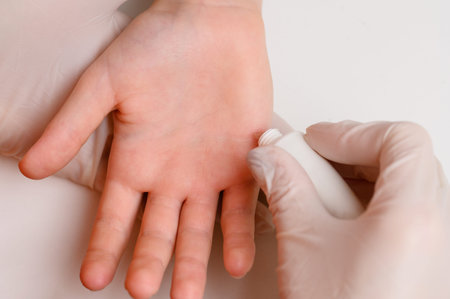 Doctor in gloves examining childs hand with viral warts, applying wart remover from tube, close-up....