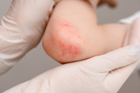 Doctor in gloves holding childs elbow, which shows noticeable red spots indicating potential problem. Childs injured elbow, with redness bothers him, scratched, close-up. Dermatological diseasesの写真素材