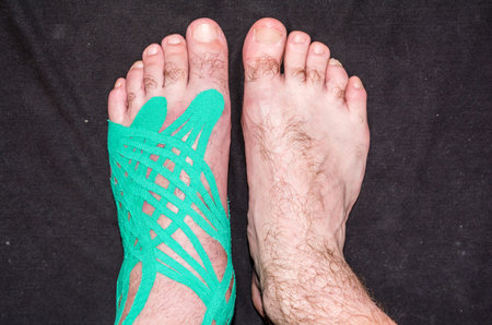 Compare foot with elastic therapeutic tape and healthy. Rehabilitation of the foot with the injury...