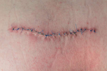 scar from operation suturated with a blue fiberの写真素材