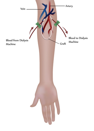 Hemodialysis procedure. Used at the renal insufficiency. のイラスト素材