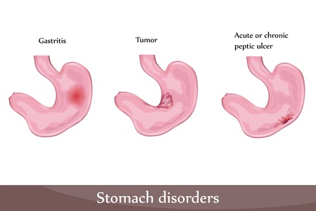 Stomach disorders- peptic ulcer, gastritis, tumor. Detailed diagram.のイラスト素材