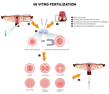 In vitro fertilization  Detailed illustrations showing egg retrieval procedure, fertilization in laboratory, fertilized egg development and embryos transfer back to the uterus のイラスト素材