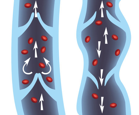 Normal vein and varicose vein illustration. Venous Insufficiency, varicose veins medical...