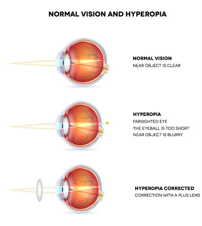 Myopia and normal vision. Hyperopia is being farsighted. Illustration shows hyperopia corrected with a plus lens. Anatomy of the eye, cross section. Detailed illustration. のイラスト素材