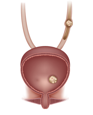 Stones in the urinary bladder and ureter. のイラスト素材