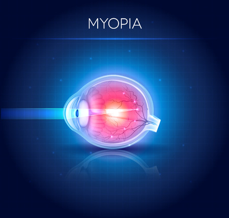 Myopia eyesight disorder. Myopia is being short sighted. Detailed illustration.のイラスト素材