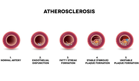 Atherosclerosis formation. Healthy artery and unhealthy arteries, showing step by step how  plaque is developing. Very detailed illustration of fatty streak formation, white blood cells infiltration, blood clot formation etc.のイラスト素材
