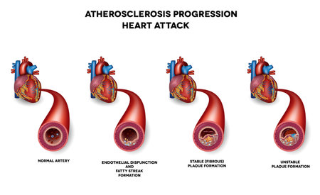 Heart attack, Coronary artery disease. Heart muscle damage due to blood clot in the artery. Very detailed illustration of fatty streak formation, white blood cells infiltration, blood clot formation etc.のイラスト素材
