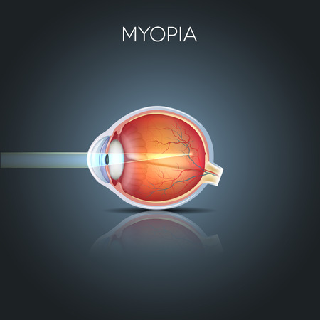 Myopia. Myopia is being short sighted (near sighted). Far away object seems blurry. Myopia corrected by a minus lens. Detailed anatomy of the eye, cross section.のイラスト素材