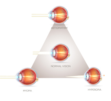 Eye vision triangle, vision disorders. Normal eye, Astigmatism, hyperopia and myopia.のイラスト素材