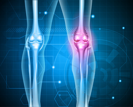 Knee pain abstract background. Healthy joint and unhealthy painful joint with osteoarthritis.のイラスト素材