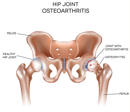 Arthritis of the hip joint, healthy joint and unhealthy joint with damaged cartilage and osteophytes.のイラスト素材