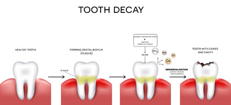 Tooth decay formation step by step, healthy tooth, forming dental plaque and finally caries and cavity Tooth decay formation step by step, healthy tooth, forming dental plaque and finally caries and cavity