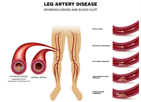 Leg artery disease and healthy artery. Peripheral Arterial Disease, Atherosclerosis progression, narrowed leg artery and at the end blood clot block artery.のイラスト素材