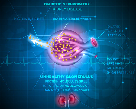 Diabetic Nephropathy, kidney disease abstract blue background. Disease caused by Diabetes.  Renal corpuscle and glomerulus, a part of the kidneyのイラスト素材