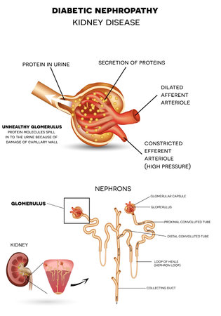 Diabetic Nephropathy, kidney disease caused by Diabetes. Detailed anatomy of glomerulus, a part of the kidney. Protein molecules spill in to the urine because of damage of capillary wall.