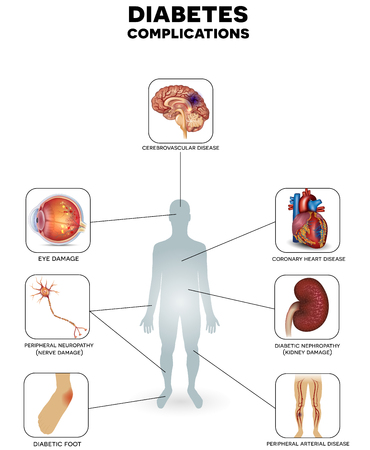 Diabetes mellitus affected areas. Diabetes affects nerves, kidneys, eyes, vessels, heart and skin.のイラスト素材