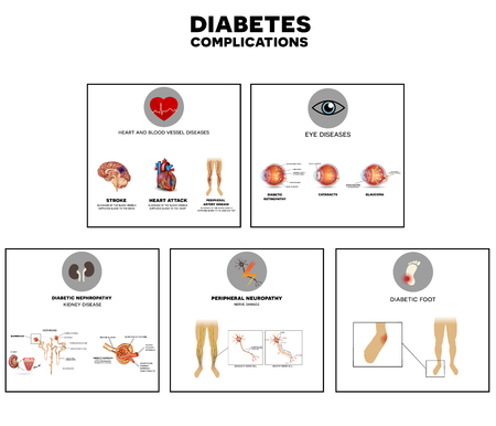 Diabetes complications affected organs. Diabetes affects nerves, kidneys, eyes, vessels, heart and skin.のイラスト素材