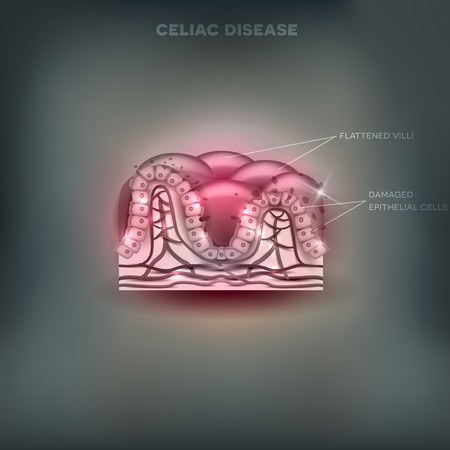 Celiac disease affected small intestine villi. Unhealthy villi with damaged cells on a beautiful grey mesh backgroundのイラスト素材