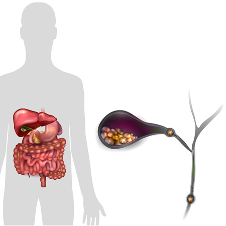 Gallstones in the Gallbladder, anatomy bright detailed illustration.のイラスト素材