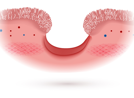 Peptic ulcer of the stomach, microscopic colorful anatomy on a white backgroundのイラスト素材