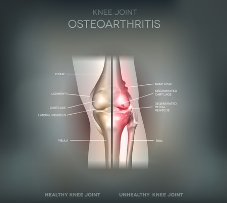 Joint problems osteoarthritis, healthy joint and damaged joint illustrationのイラスト素材