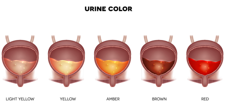 Urine color chart from light yellow till red color. Urinary bladder detailed anatomy and urine inside.のイラスト素材
