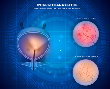 Urinary bladder surface examination with Cystoscope closeup of healthy lining and unhealthy cystitis on an abstract blue backgroundのイラスト素材