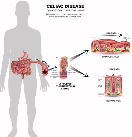 Celiac disease affected small intestine villi. Damaged cells by body's reaction to gluten. Intestinal villi do not absorb nutrients because of reduced surface area. Healthy villi and unhealthy villi on a white background.のイラスト素材