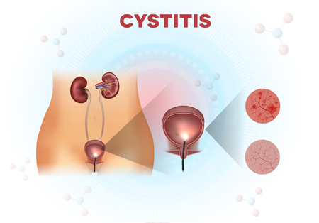 Urinary system anatomy, urinary bladder examination, normal and unhealthy lining with cystitis on a light abstract scientific backgroundのイラスト素材