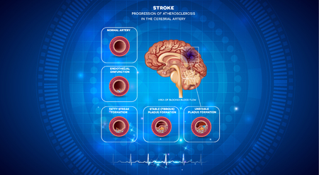 Stroke, blood clot formation in the brain artery, brain damage. Abstract blue technology background with cardiogram.のイラスト素材