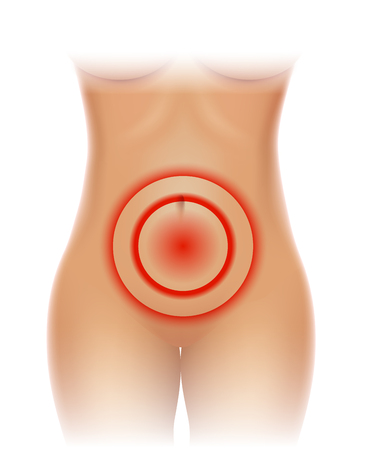 Female Pelvic pain, lower abdominal painのイラスト素材