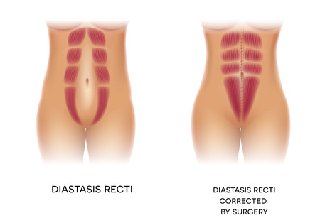 Diastasis Recti also known as Diastasis Rectus Abdominis or abdominal separation, it is common among pregnant women and post birth. Before and after surgery correction.のイラスト素材