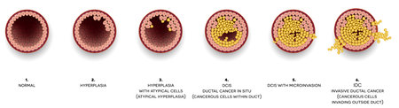Vector of Breast cancer Ductal carcinoma - ID:1-117791197 - Royalty ...