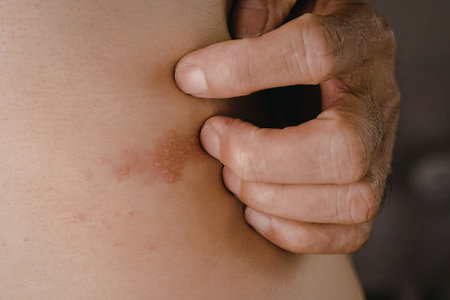 A close-up image of a hand gently holding a bruised area on the arm. The bruise appears red and slightly swollen, indicating recent injury.の写真素材